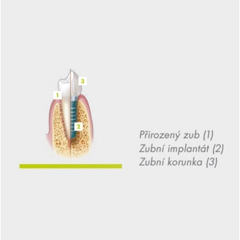 Dentální implantáty - foto č. 1